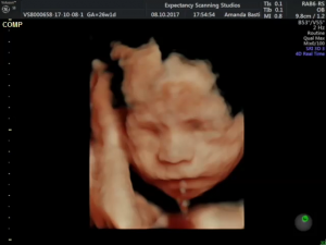 Baby scan